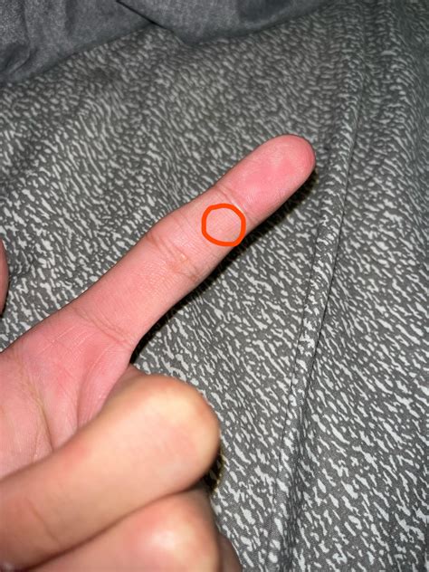 Is this a common wart on my finger? : r/Warts
