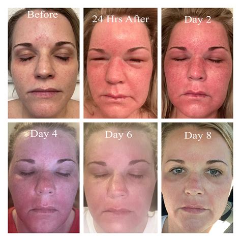 lasers on face 5
