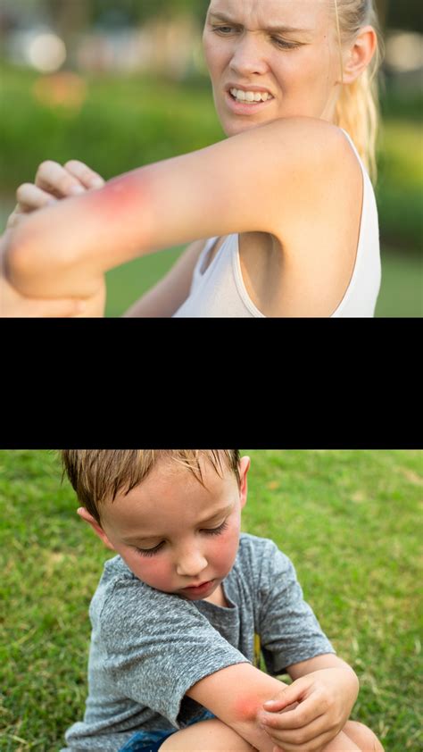 Want to know what actually stops mossie bites itching? Here’s what