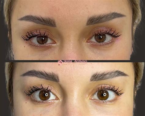 Upneeq Eye Drops - Before and After Results