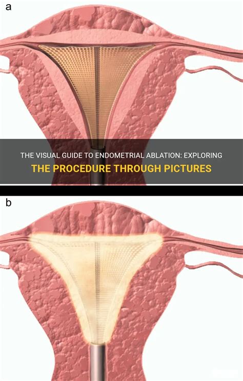 The Visual Guide To Endometrial Ablation: Exploring The Procedure ...