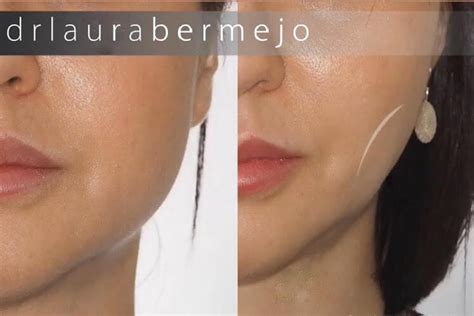 Bichectomía en A Coruña - Dr. Laura Bermejo
