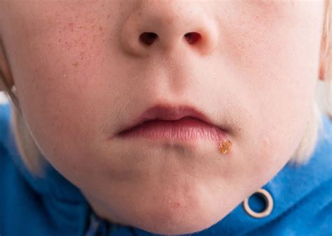 impetigo  mouth