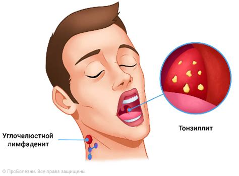 Ангина гнойная как называется