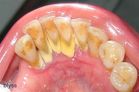 Coffee Stained Teeth? It May Not Be Because Of Your Daily Brew