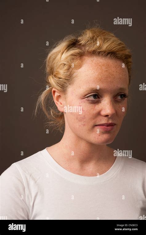 Port wine birthmark face hi-res stock photography and images - Alamy