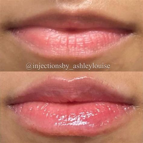 lip filler defined cupids bow  gary delariva blog