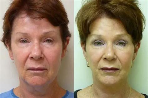 facelift    treatment results