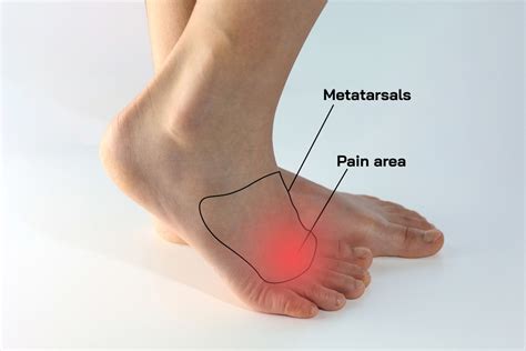 5 Exercises for Morton's Neuroma: Alleviate Your Foot Pain - Custom ...