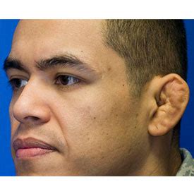 Cauliflower Ear Surgery