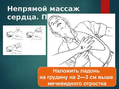 Сердечнолёгочная реанимация - online presentation