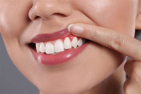 how long does it take gums to heal after extraction