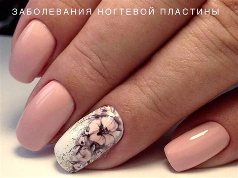1.Онихолизис - пластина отслаивается от ногтевого ложа. Не заразен ...