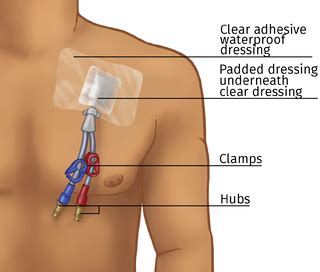 types  vascular access ports   hemodialysis vascular access