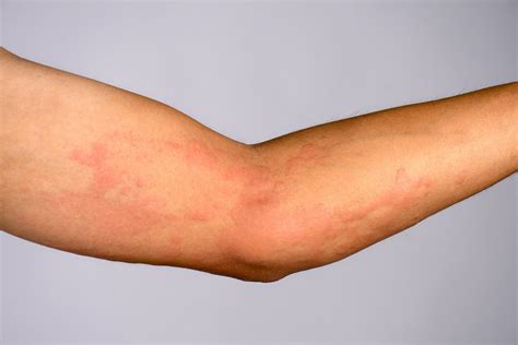 Eczema and Hives: Identifying and Managing Them Successfully
