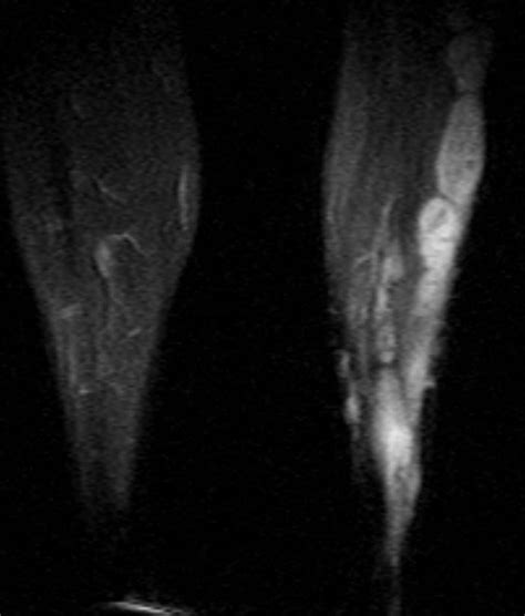 My Radiology World: Intresting Neurofibroma