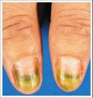 Green Nail Syndrome | Share All Knowledge