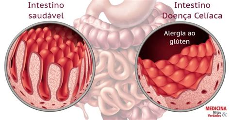 Doença Celíaca É Autoimune - Alergia ao glúten: doença celíaca pode provocar a morte | Medicina ...
