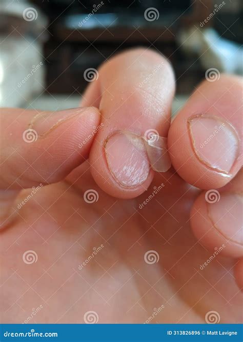 A fingernail peeling off stock photo. Image of peeling - 313826896