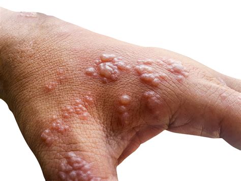 Monkeypox: Risk factors, severity and more | News