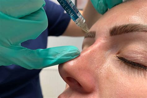 Nose Bump Treatment - Freyja Medical