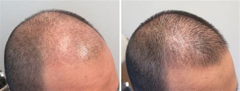 Finasteride Before and After Photos [2022]