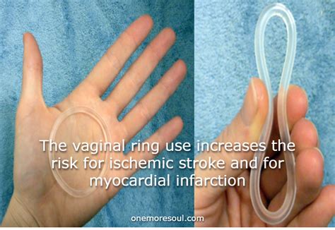 ring contraceptive side effects