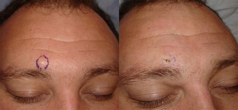 Sebaceous Cyst Face Removal