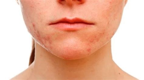 Espinhas No Queixo O Que Pode Ser - Espinhas no queixo: O que pode ser e como tratar - HPG