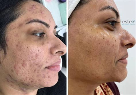 pixel laser resurfacing este medical group