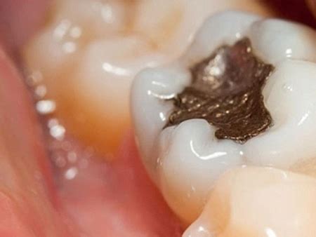 devitalized tooth  problems  arise