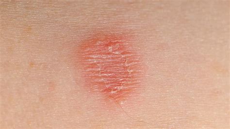 Early Stages Of Ringworm Find Your Dog Relief From Ringworm In Its