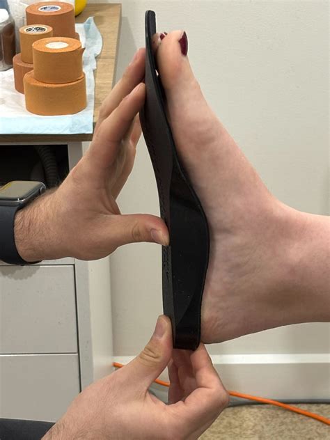 How Custom Orthotics Can Help Manage Bunions | Adelaide Bunion Clinic