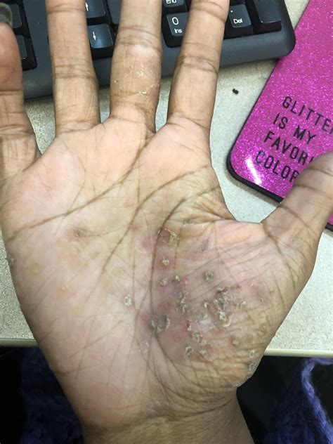 Eczema Blisters On Hands Eczema Left Me Bleeding And Blistered, Then I