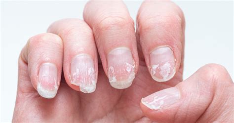 10 Reasons Your Nails are Peeling and Flaking : The Hearty Soul