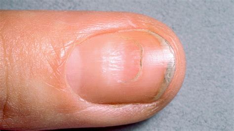 Dark Lines On Nails Treatment at Ruth Layton blog