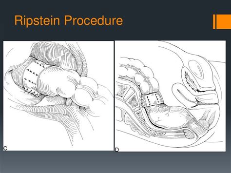 Rectal prolapse