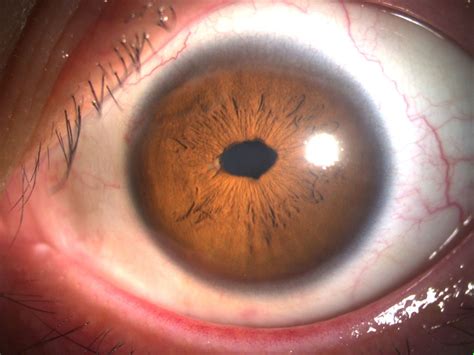 anterior segment photographs   left eye  postoperative day