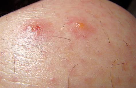 What do chigger bites look like? Photos to help identify and treat them