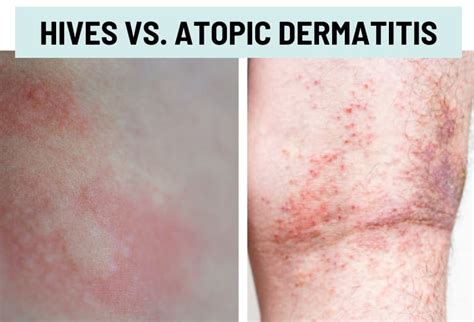 Hives (Urticaria) vs. Rash: Pictures and Differences