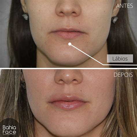Preenchimento Para O Rosto - Preenchimentos Faciais | Bahia Face