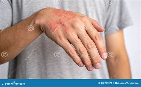 hand eczema red rash itchy skin dry patch irritated skin atopic