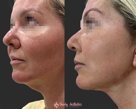 PDO Thread Lifting - Before and After Results at Skinly Aesthetics