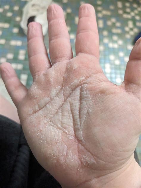 Anyone familiar with aquagenic wrinkling of palms? : r/SkincareAddicts