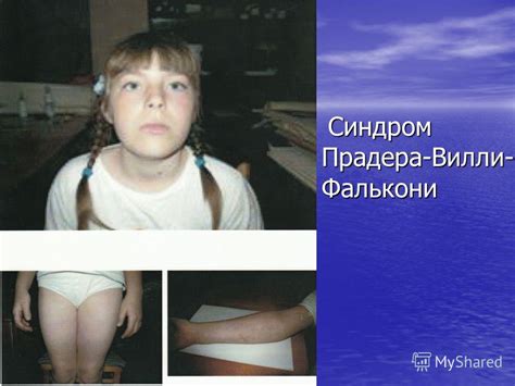 Синдром Прадера-Вилли фото