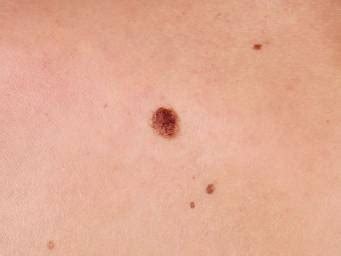 What causes a bleeding mole? - www.MedicalTalk.Net the Best Medical ...