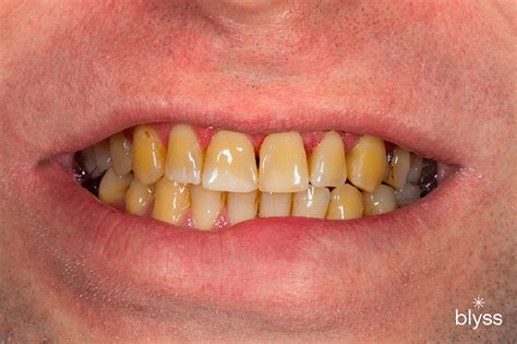 coffee stained teeth        daily brew