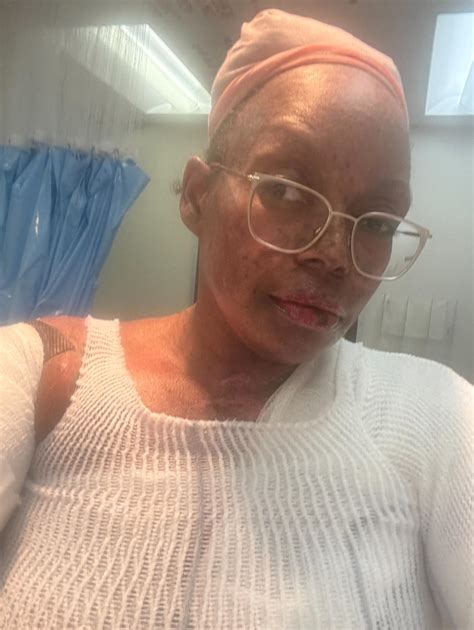 AshLee - 🔎 Understanding Toxic EpidermaNecrolysis ( TEN) 🔎 Toxic