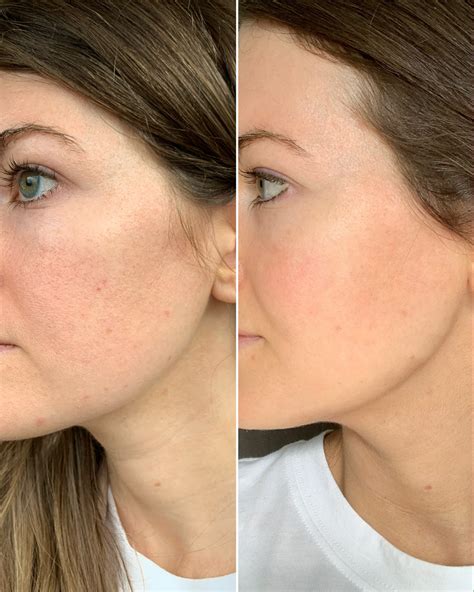 Unbelievable Blackhead Removal 2024: My Honest Review & Before/After Pics. Image 16