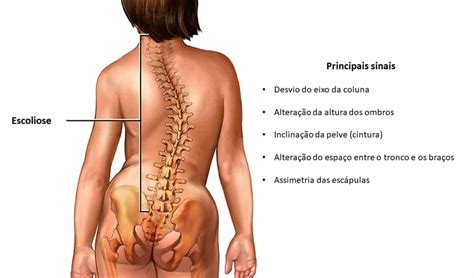 O'que É Escoliose Na Coluna - Tratamento da Escoliose - Dr. Ricardo Teixeira